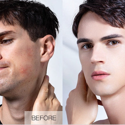 Plant Extract Warm And Moisturizing Herbal Acne Cream