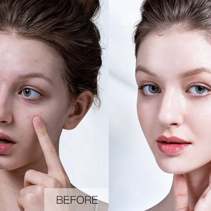 Plant Extract Warm And Moisturizing Herbal Acne Cream