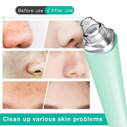 USB Rechargeable Vacuum Pimple Extractor Machine